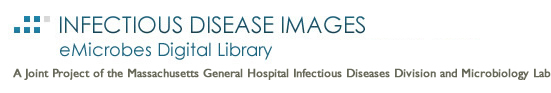 Partners Infectious Disease Images