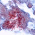 Nontuberculous Mycobacteria