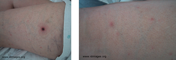 <p>A middle-aged woman noted a “bite” on her left thigh. During the next week, the lesion enlarged, and fatigue, arthralgias, myalgias, a severe headache and a fever to 103.4°F (39.7°C) developed, followed by a rash on her extremities, trunk and back. She had moved to the Northeast from the South 6 months before, had a pet dog, and had noticed a mouse in her basement.</p>
<p><b>The most likely diagnosis is which of the following?</b></p>