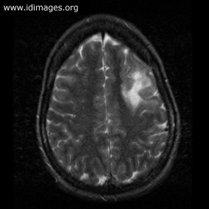 <p>Magnetic resonance imaging (MRI) of the brain of a woman in her thirties with word-finding difficulties, expressive aphasia and right arm weakness of 4-weeks' duration is shown (axial T2-weighted image).  Testing for antibodies to HIV was positive, the white cell count was 2200 per cubic millimeter (44% neutrophils, 45% lymphocytes) and CD4 T-cells were 20 per cubic millimeter.</p>
<p><b>The most likely diagnosis is which of the following?</b></p>