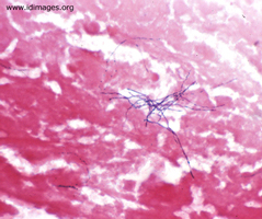 <p>A woman with diabetes mellitus had fever and anorexia two months after gastric biopsy. Gram stain of an aspirate of a liver abscess is shown.</p>
<p><b>The most likely diagnosis is which of the following?</b></p> 