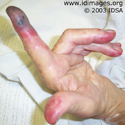 <p>An elderly woman developed acrocyanosis, pain and numbness in her fingers several days after sustaining a scratch on her left index finger by a turtle. She also had malaise, weakness, nausea, vomiting and diarrhea. She lived in a rural area of the Southwest US and owned several dogs. On exam, she was febrile and hypotensive. Skin findings are <strong>shown</strong>. Six of six blood culture bottles grew gram negative rods.</p>
<p><b>The most likely diagnosis is which of the following?</b></p>