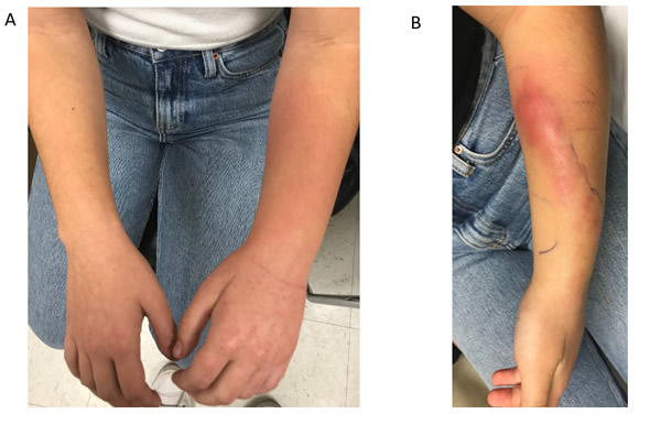 A young girl presents with a progressively tender and swollen left forearm despite 2 days of intravenous cefazolin followed by 9 days of ceftriaxone, administered via outpatient parenteral antibiotic therapy (OPAT). She was afebrile. Photographs of her left forearm taken on the day of initial presentation (A) and day 11 (B) of antibiotics are shown. What is the diagnosis?
