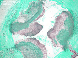 Figure 3.  Giemsa stain showing  <i>Aspergillus fumigatus</i> 