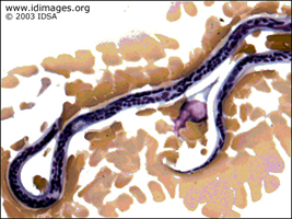 Figure 1.  Nocturnal blood smear showing  <i>Wuchereria bancrofti</i>.