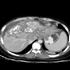 Mycobacterium tuberculosis