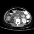 Mycobacterium tuberculosis