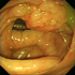 Mycobacterium tuberculosis