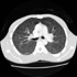 Mycobacterium tuberculosis