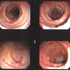 Cytomegalovirus