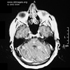 Mycobacterium tuberculosis