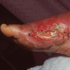 Vibrio vulnificus