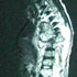 Mycobacterium tuberculosis