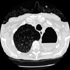 Mycobacterium avium Complex