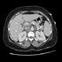 Mycobacterium tuberculosis