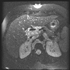 Mycobacterium tuberculosis