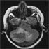 Mycobacterium tuberculosis