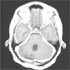 Mycobacterium tuberculosis