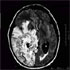 Mycobacterium bovis