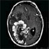 Mycobacterium bovis