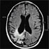 Mycobacterium bovis