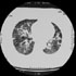 Cryptococcus neoformans