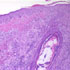 Leishmania braziliensis