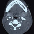 Mycobacterium tuberculosis