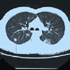 Mycobacterium tuberculosis