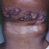 Mycobacterium tuberculosis