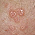 Molluscum contagiosum virus