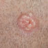 Molluscum contagiosum virus