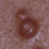 Molluscum contagiosum virus