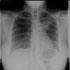 Mycobacterium tuberculosis