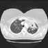 Mycobacterium tuberculosis