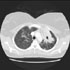 Mycobacterium tuberculosis