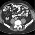 Herpesvirus 4, Human (Epstein Barr Virus)