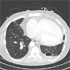 Nontuberculous Mycobacteria