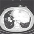 Nontuberculous Mycobacteria