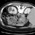 Mycobacterium tuberculosis