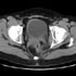 Mycobacterium tuberculosis