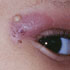 Molluscum contagiosum virus