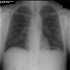 Mycobacterium tuberculosis