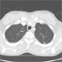 Mycobacterium tuberculosis