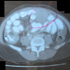 Mycobacterium tuberculosis