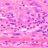 Cytomegalovirus