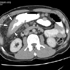 Mycobacterium tuberculosis