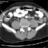 Mycobacterium tuberculosis