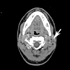 Mycobacterium tuberculosis