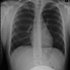 Mycobacterium tuberculosis